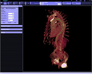 Stent Expansion